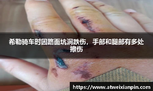 希勒骑车时因路面坑洞跌伤，手部和腿部有多处擦伤
